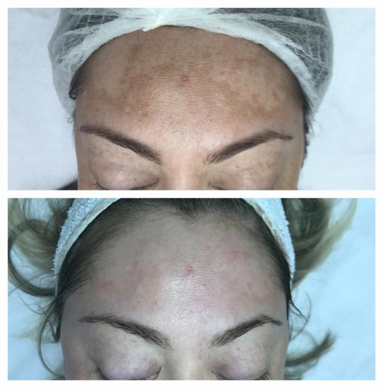 Microagulhamento para Cicatriz de Acne Vila Santa Luzia - Microagulhamento Facial