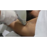 depilação a laser masculina ALTO DE SANTANA