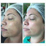 microagulhamento acne Serra da Cantareira